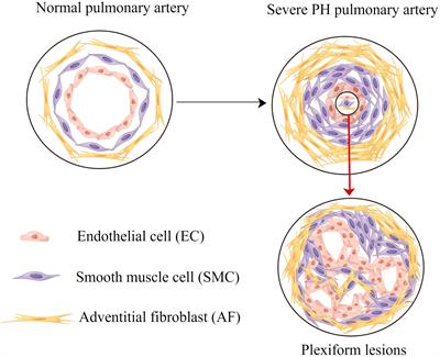 Myeloid-derived suppressor cells and pulmonary hypertension